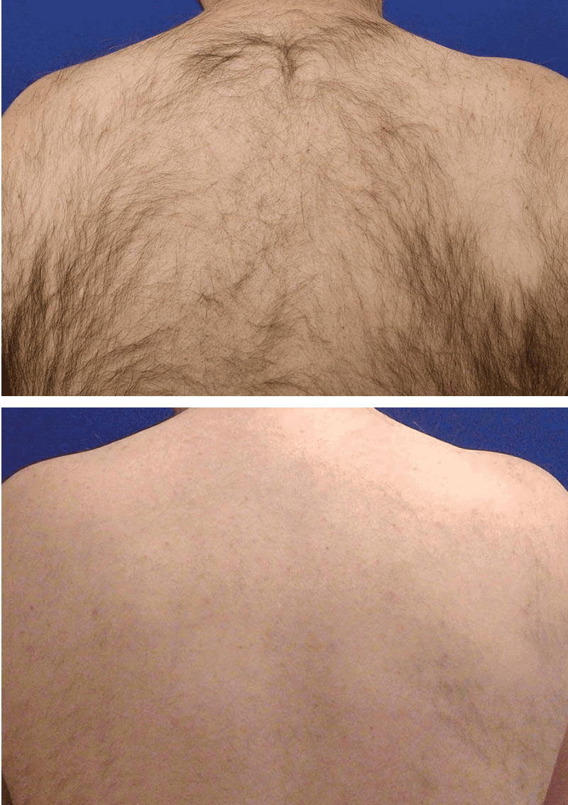 Hair removal before-after