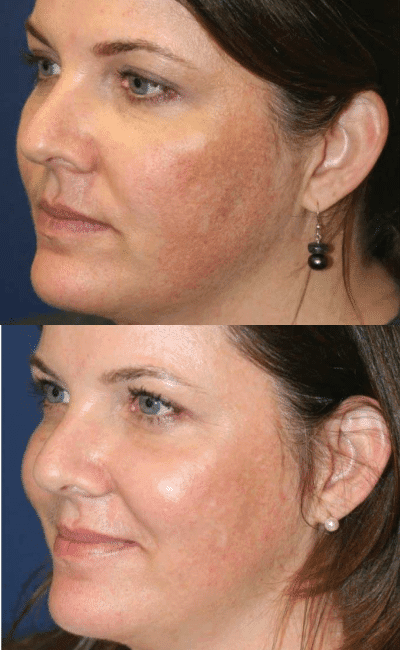 CO2 Laser Resurfacing