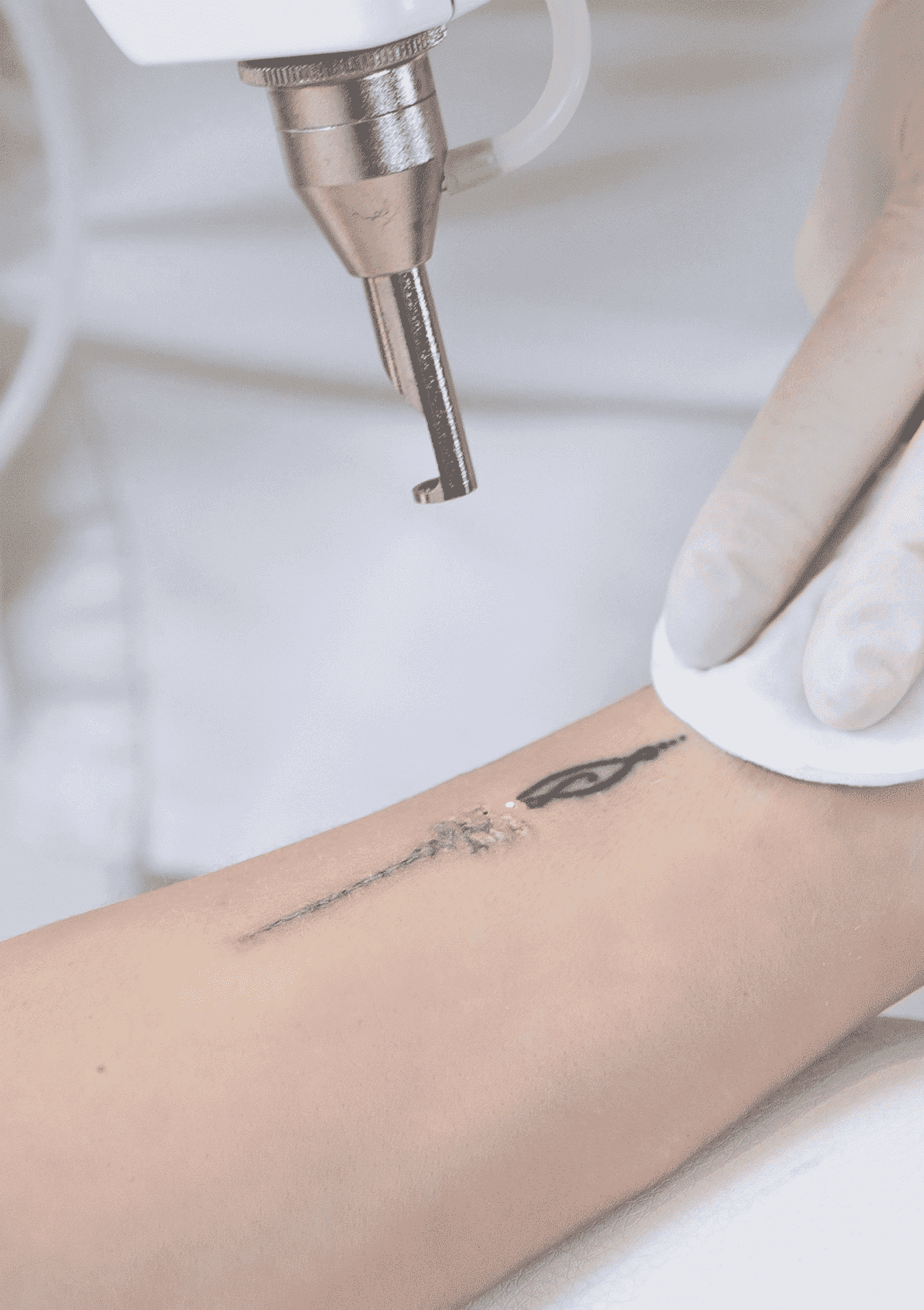 Laser Tattoo Removal