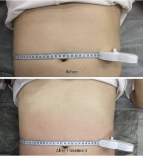 Before After Treatment