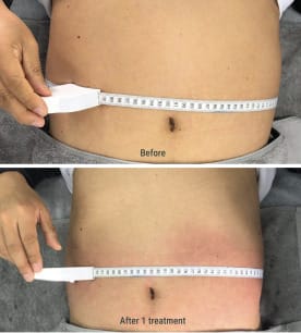 Before After Treatment