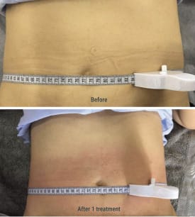 Before After Treatment