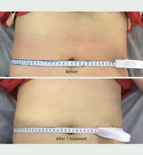 Before After Treatment