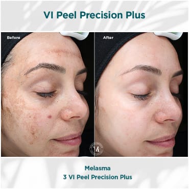 Melasma Vi Peel