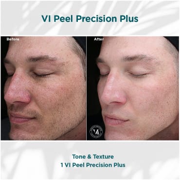 Tone Texture Vi Peel