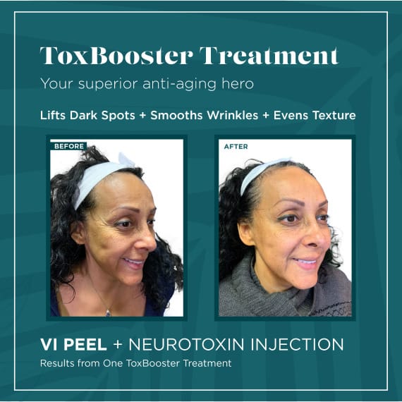 Toxbooster Treatment Vi Peel