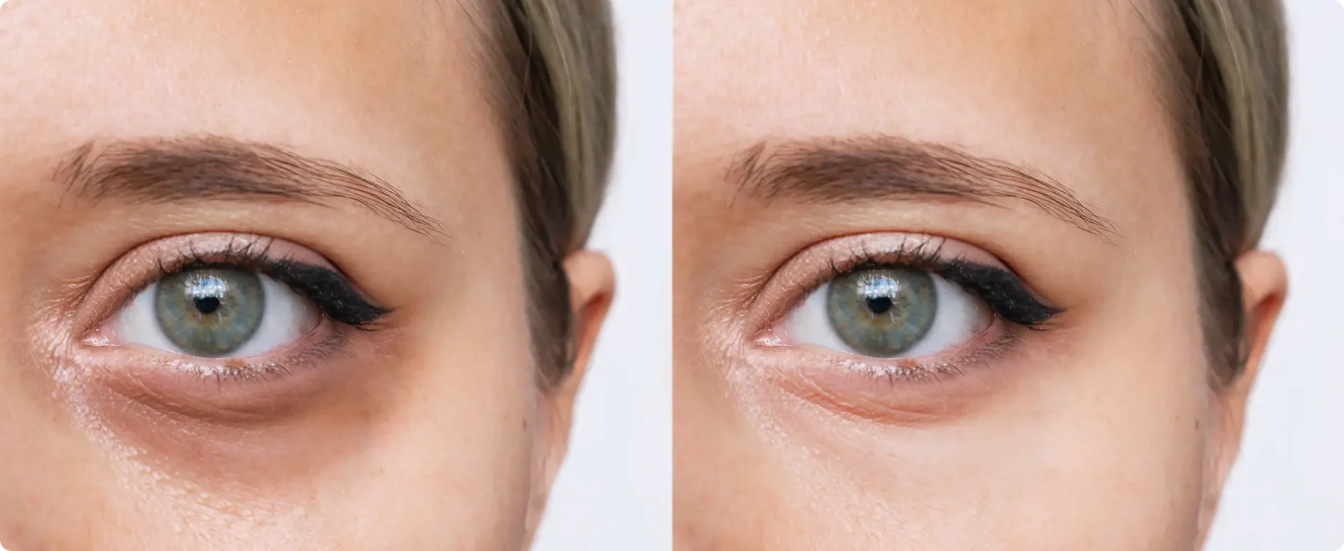 ezPRF Under Eye imge