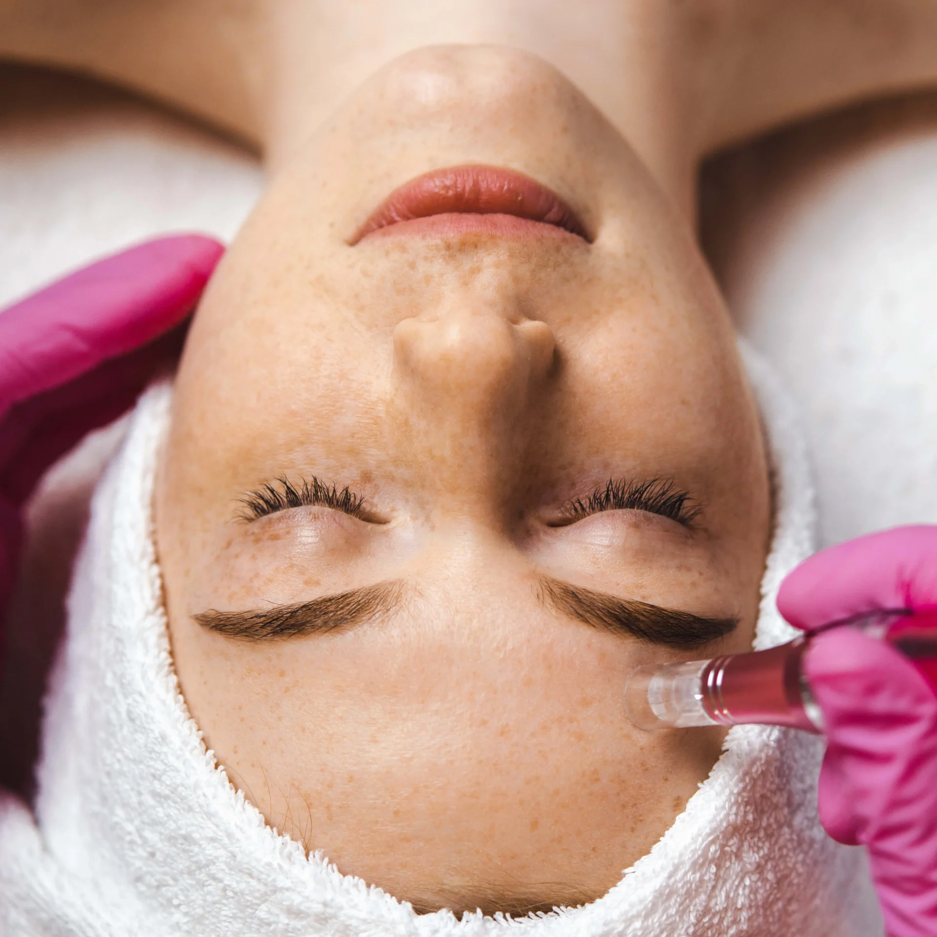 RF Microneedling Treat