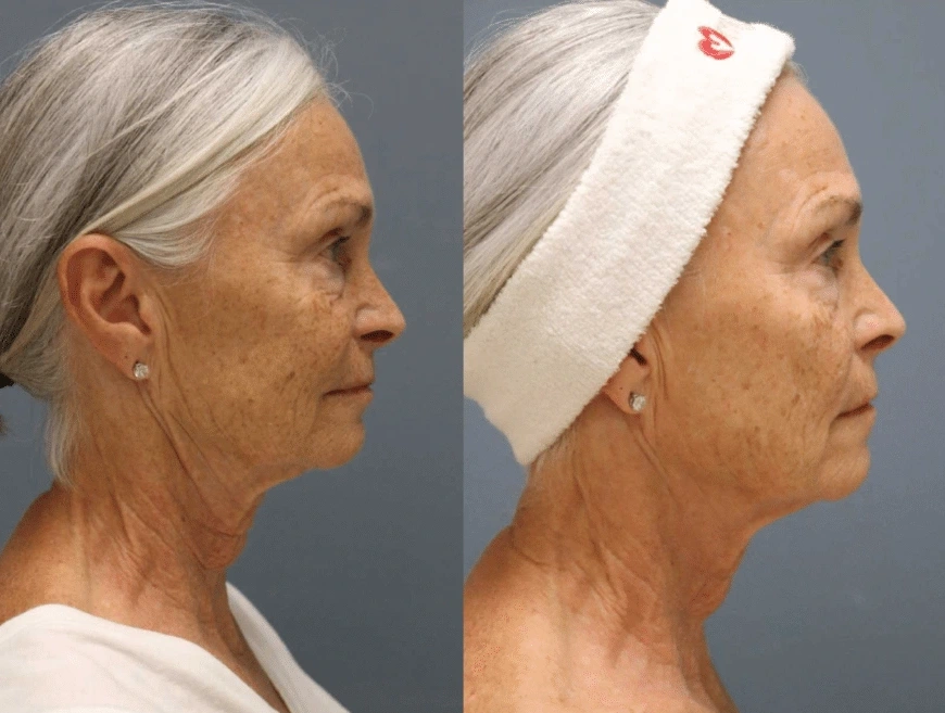 rf-microneedling-pricing-