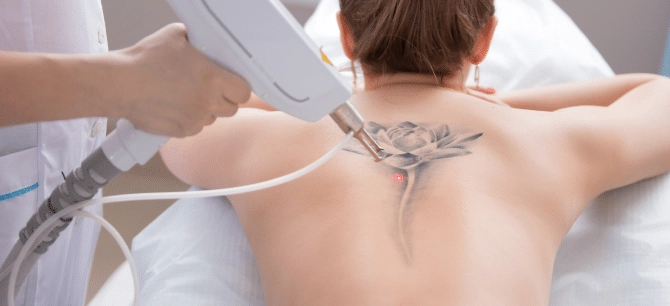 tattoo-removal