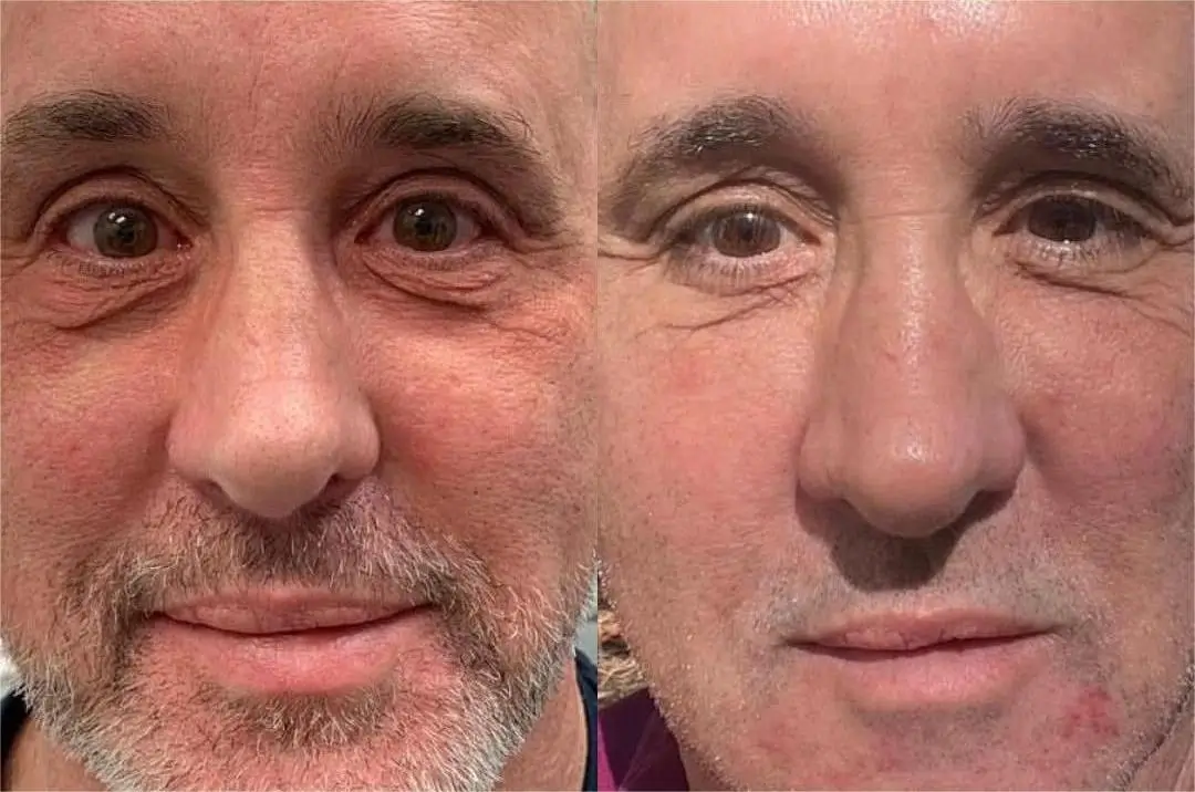 CO2 Laser Resurfacing After Before CO2 Laser Resurfacing After Before