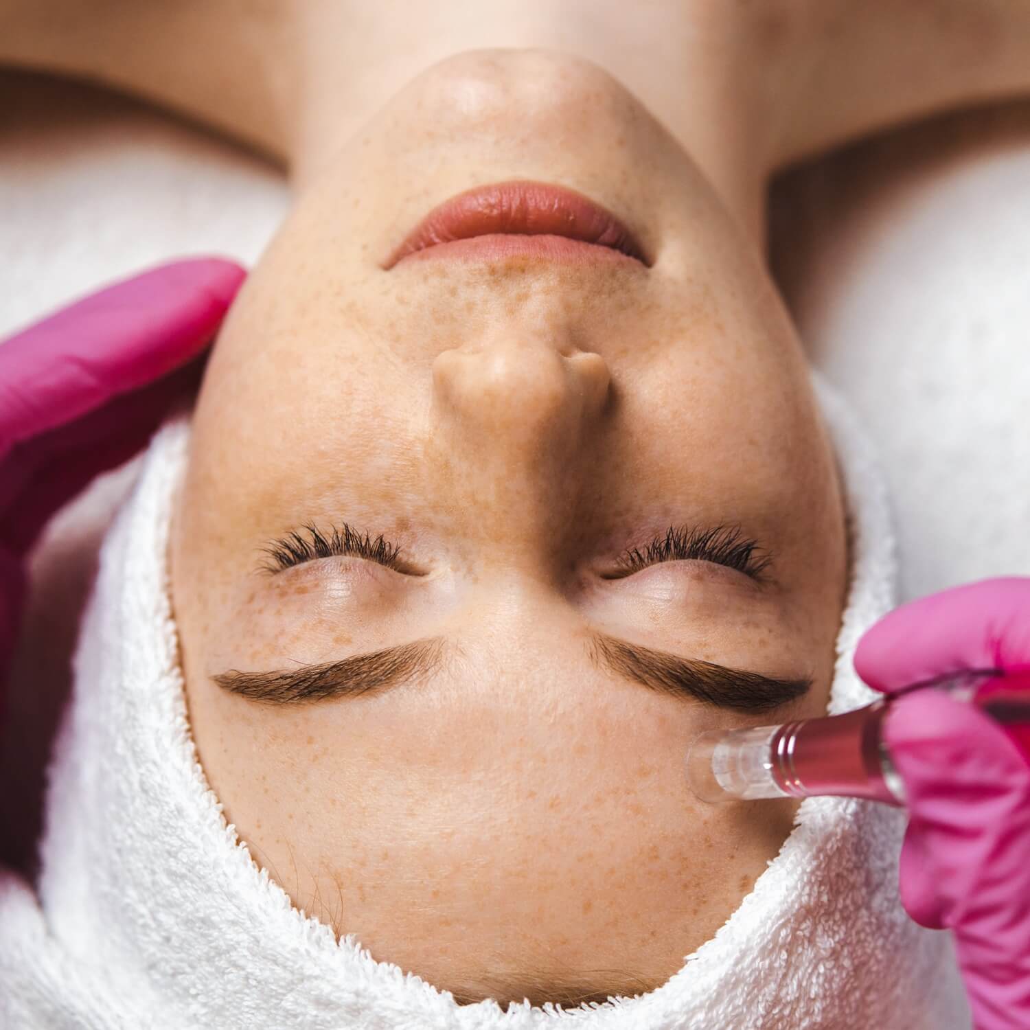 PRP-Facial-Treatment-01 PRP-Facial-Treatment-01