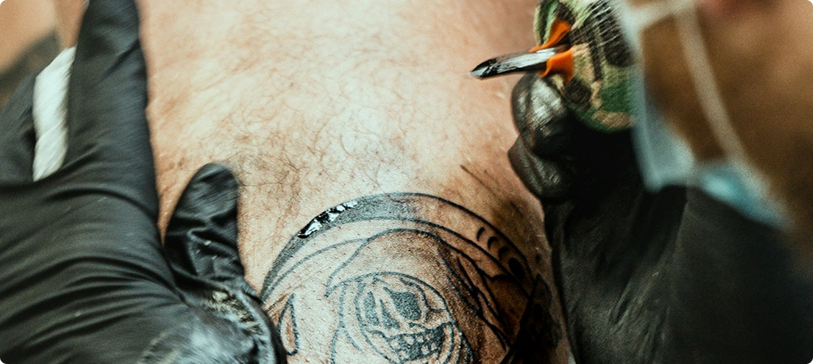 Laser Tattoo Removal img